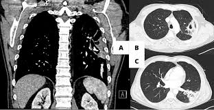 Image result for Lung Abscess