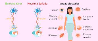 Jul 02, 2021 · trastornos cerebrales, como un accidente cerebrovascular, esclerosis múltiple o parálisis cerebral; Consecuencias De La Esclerosis Multiple