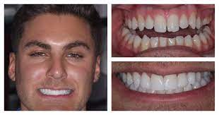 How long does dental bonding last. Dental Bonding In Durham Newcastle The Cosmetic Dental Clinic