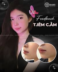 🌸 FEEDBACK T.IÊM C.ẰM 🌸 Nàng tìm đến Daisy với mong muốn gương m.ặt có tỷ  lệ hài hòa hơn, đường nét gọn gàng và thanh tú hơn nhưng vẫn giữ được