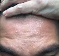 Syameel On Twitter Tiny Bumps Atau Dikenali Sebagai Jerawat Pasir Adalah Sejenis Jerawat Halus Bersaiz Kecil Yang Tumbuh Secara Berkelompok Di Bahagian Muka Yang Berminyak Terutamanya Di Kawasan Dahi Dagu Serta Pipi
