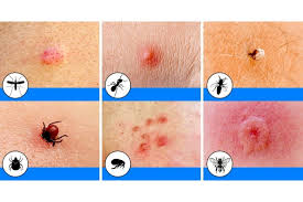 Bug Bites That Look Like Mosquito Bites But Hurt 10 Insect Bites To Look Out For This Summer And How To Treat Them Towntalk Radio