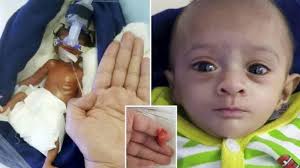 Pasaran kedua calon itu adalah : Lahir Tanpa Bernafas Kulit Setipis Coklat Ini Bayi Terkecil Di Asia Halaman 1 Tribun Manado