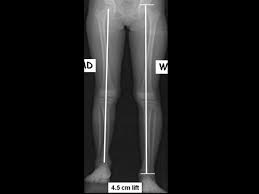 Leg Length Discrepancy Lld Pediatrics Orthobullets