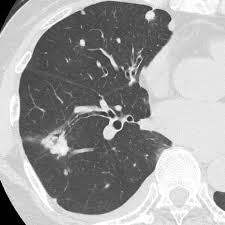 A grade of c or better in ( bio160 or bio201) and ( hcc145 or hcc146 ), or a graduate of a related medical program of study or currently registered as a technologist in radiography, nuclear medicine, radiation. Aquilion Precision Ct Scanner Computed Tomography Ct System Canon Medical Systems Usa