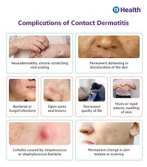 Image result for contact dermatitis