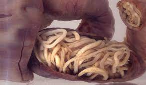 Enterobius vermicularis · pinworm · threadworm. Anemia Dek Cacing Harian Metro
