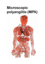 Image result for Microscopic Polyangiitis