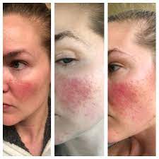 The lowest goodrx price for the most common version of generic soolantra is around $139.27, 75% off the average retail price of $569.86. Losing Hope 4 Weeks Of Soolantra And Zero Improvement I Really Thought This Would Work For Me More In Comments Rosacea