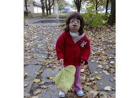 Two of the children suffered from franceschetti syndrome and one child from goldenhar's syndrome. Shirley Uros Lifetool