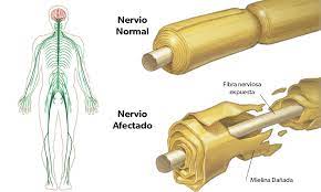 We did not find results for: El Sindrome De Guillain Barre Como Afecta A Nuestra Salud Medidas Preventivas Y Fisioterapia En La Recuperacion De Las Secuelas Clinica Ecomusculo
