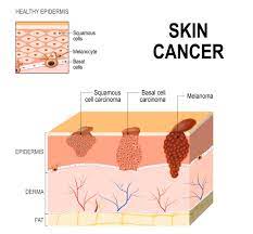 More than 60,000 people are diagnosed with melanoma every year, with nearly 9,000 deaths, according to skin cancer foundation data. What To Watch Out For Early Signs Of Skin Cancer