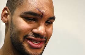 Maple Leafs' Mark Fraser makes no bones about X-ray