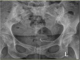 Unfortunately, iud usage is also often associated with cramps. Cystoscopic Removal Of A Migrated Intrauterine Device To The Bladder A Case Report Contraception And Reproductive Medicine Full Text