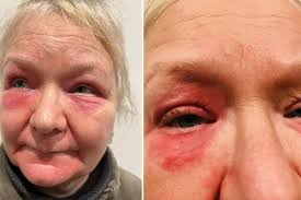 Tavistock woman to sue NHS after brain aneurysm