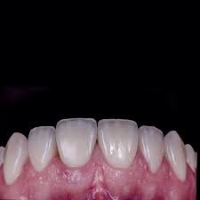 Dr Alejandro Lanis On Instagram Veneers Follow Up 6 Months Dentogingival Integration Dsd D Aesthetic Dentistry Dental Anatomy Dental Veneers