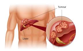 The gallbladder extracts water from its store of bile until the liquid becomes highly concentrated. Fighting Liver Cancer Symptoms Diagnosis Treatments