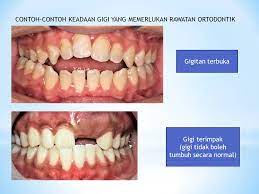 Kawat gigi tidak akan terlihat oleh siapa pun kecuali pemakai nya yang merasakan sendiri. Wah Pejabat Kesihatan Pergigian Daerah Kuala Krai Facebook