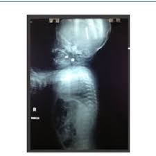 X Ray Shunt System Revealed Disconnected Shunt Distal To The Valve Download Scientific Diagram