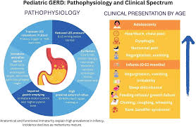 Image result for Pediatric Reflux