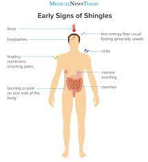Shingles prevention · shingles causes · condition information The Early Stages Of Shingles Signs And Symptoms