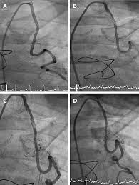 Maybe you would like to learn more about one of these? Management Of Atherosclerotic Plaque In Left Internal Mammary Artery Graft Five Years After Angiographic Patency A Case Report