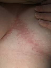 Image result for heat rash under breasts