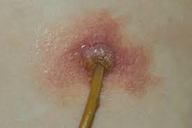 Infected And Overgranulated Percutaneous Endoscopic Gastrostomy Site Download Scientific Diagram