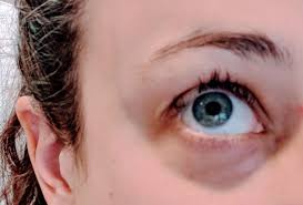 Losing eyelashes can lead to some social anxiety due to the change it can make to your appearance. Eyelashes Randomly Falling Out Album On Imgur