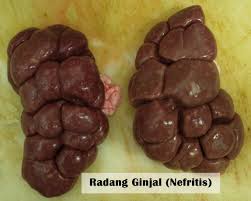 Hasil gambar untuk nefritis