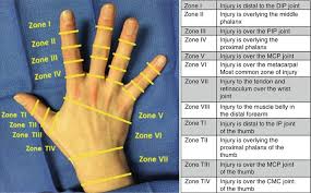 Image result for Elson Extensor Tendon Test