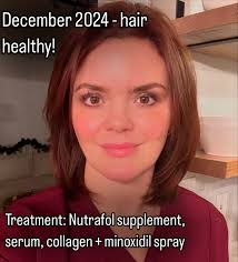 💯 Vulnerable Post I'm keeping it real and opening up about one of my  biggest insecurities: **hair loss.** As someone being treated for Crohn's  disease—an autoimmune condition I've had since my teens—I've