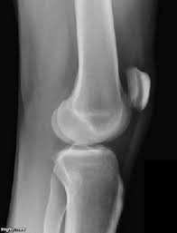 Image result for Knee XRay