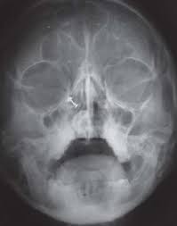 In pns, eve splits off a single photon or a small number of photons from each bit transmission for measurement and allows the rest to pass on to bob. Pns View Showing Radiopaque Mass On The Right Nasal Cavity Download Scientific Diagram