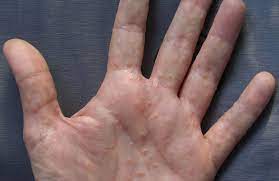 Marly Skin Das Original Hautschutzschaum Bei Dyshidrosis Marly Skin
