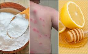 Alivie As Picadas De Pulgas Com 5 Remedios Naturais Melhor Com Saude