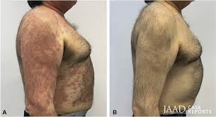 Image result for Hypertrichosis