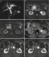 Purpose to evaluate the diagnostic performance of ct in the determination of pancreatic cancer resectability according to the national comprehensive cancer network (nccn) criteria to predict r0 resection. Imaging Diagnosis Of Pancreatic Cancer Ct And Mri Oncohema Key