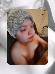 What is the worst symptom you have to manage?