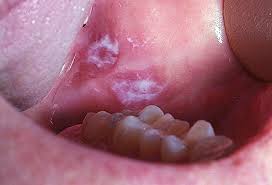 Image result for dental cancer
