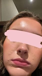 Does anybody know what this acne is and how to treat, it is weirdly uniform 