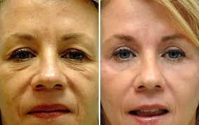 All subscriptions include exclusive subscriber offers, events and giveaways with west rewards, our subscriber rewards program. Upper Eyelid Surgery Cost Cheaper Than Retail Price Buy Clothing Accessories And Lifestyle Products For Women Men