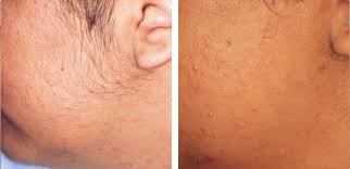I also started using face mists and added extra moisturisers to my regime as i got a bit more dry. Best Laser Hair Removal In Dubai Abu Dhabi Cmc Hair Removal