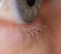 Entzündungen am auge sind ein sehr häufiges medizinisches problem und in ursache, auswirkung und lokalisation extrem vielfältig. Augenlid Hygiene Pflege Ocular Surface Center Berlin