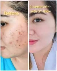 SY GLOW Rejuvenating Set ✔️Anti-Pimples ✔️Anti-Aging ✔️Lessens the  appearance of Freckles, Melasma and Dark Spots ✔️Flawless White and Glowing  Skin SY GLOW GLASS SKIN SET 🥰removes melasma 🥰can treat pimples and acne