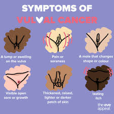 Image result for Vulvar Cancer