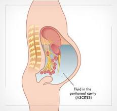 Image result for Rectal prolapse