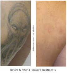 The decomposition isn't harmful, but if the fizz is gone when you're beginning cleaning, you're just using plain water. Picosure Tattoo Removal Of A Shaded Image Austinpicosure Com A Tattoo Removal Nurse S Notes