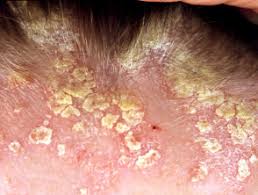 Scalp psoriasis requires slightly different regimes from psoriasis affecting the skin elsewhere. Scalp Psoriasis Dermnet Nz