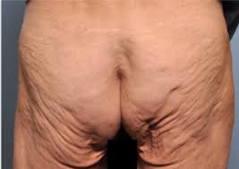 After that, put it in a strainer and separate the water from the paste. Sagging Butt Plastic Surgery Blog Buildmybod